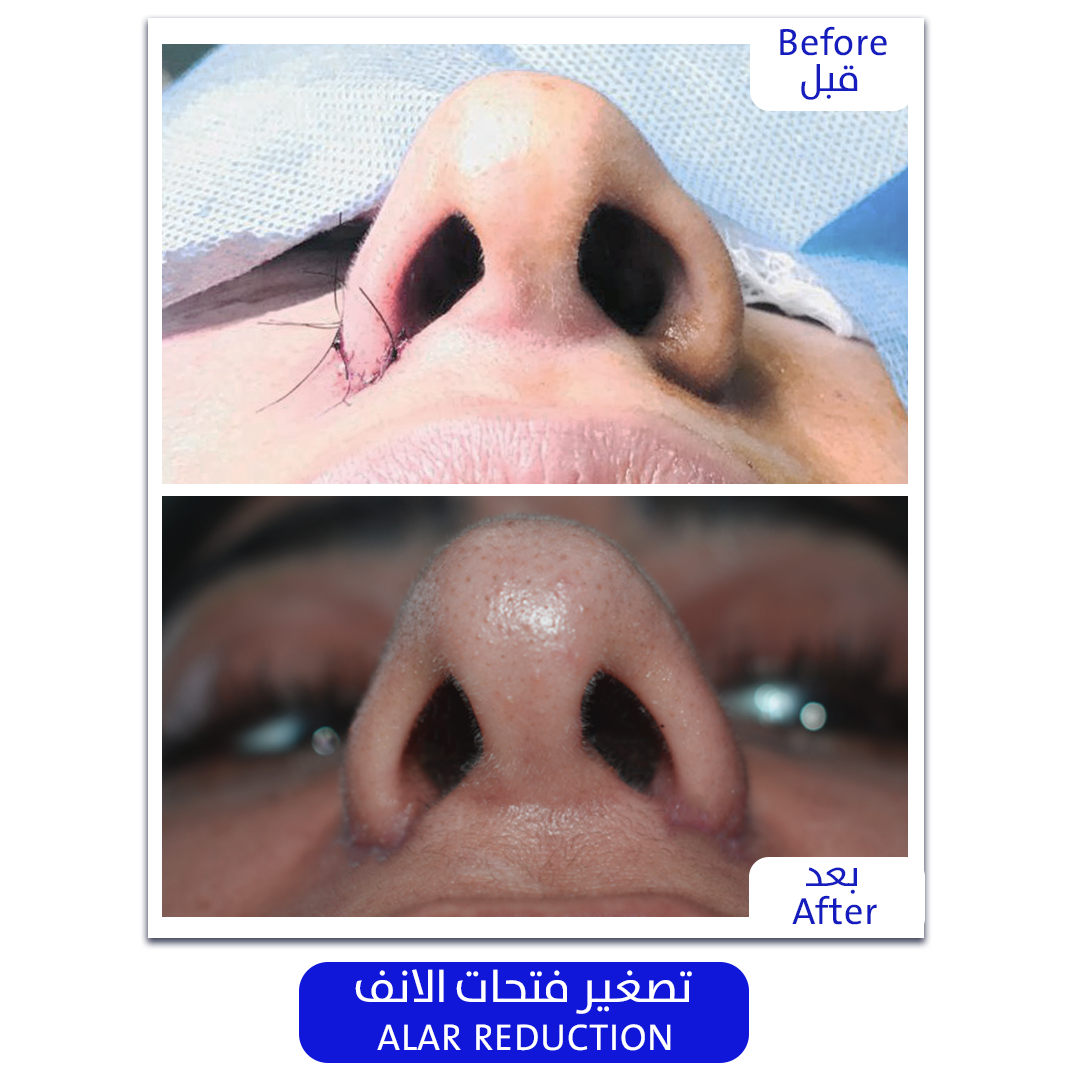 Plastic_Surgery_ALAR