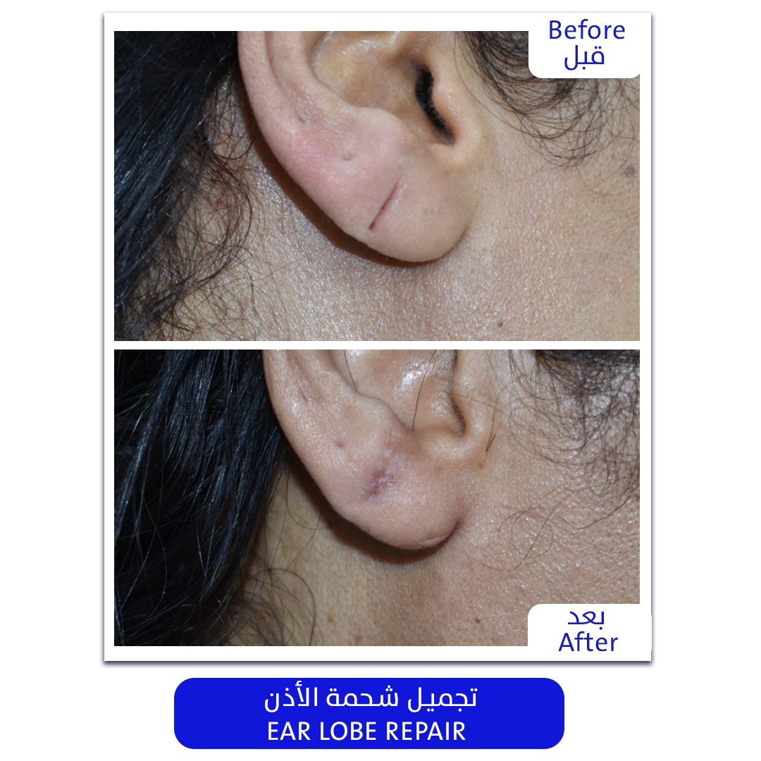 Plastic_Surgery_EarLobe