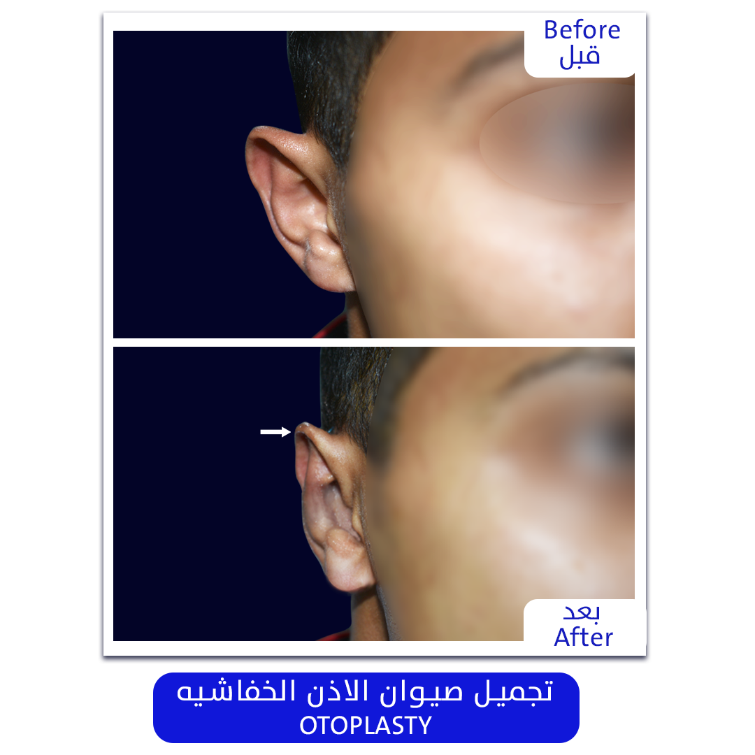 Plastic_Surgery_OTOPLASTY