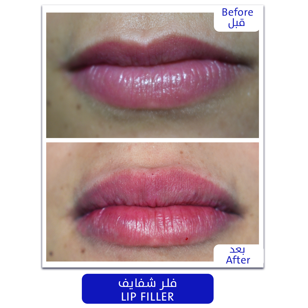 Plastic_Surgery_lipfiller