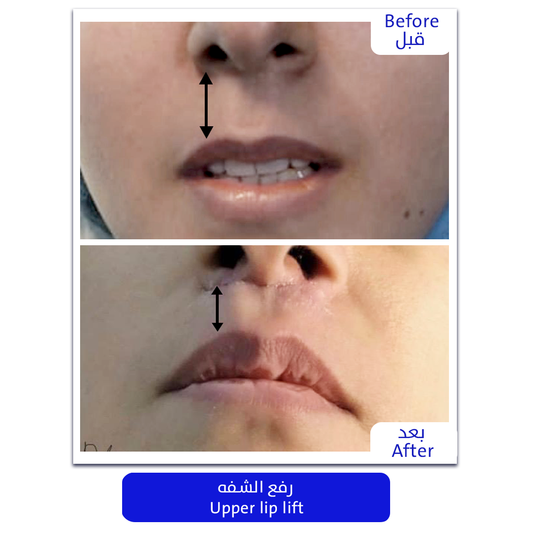 Lip Filler Treatment